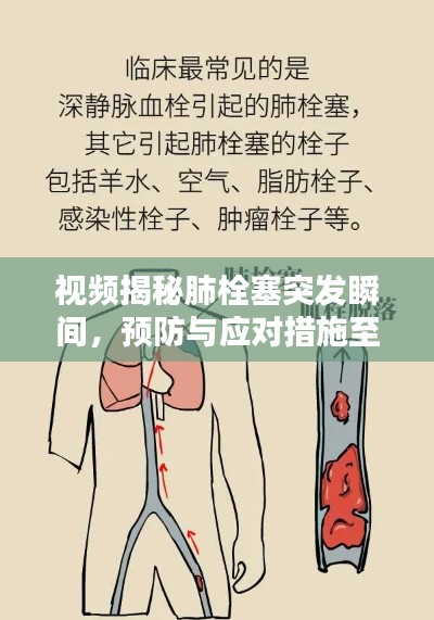 视频揭秘肺栓塞突发瞬间，预防与应对措施至关重要