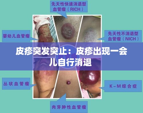 皮疹突发突止：皮疹出现一会儿自行消退 