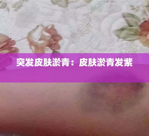 突发皮肤淤青：皮肤淤青发紫 