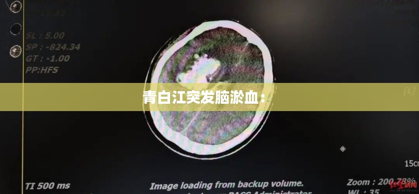 青白江突发脑淤血： 