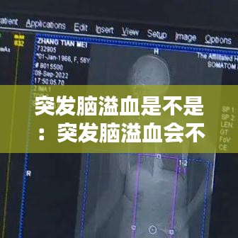 突发脑溢血是不是：突发脑溢血会不会死 