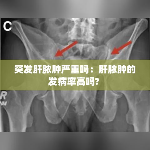 突发肝脓肿严重吗：肝脓肿的发病率高吗? 