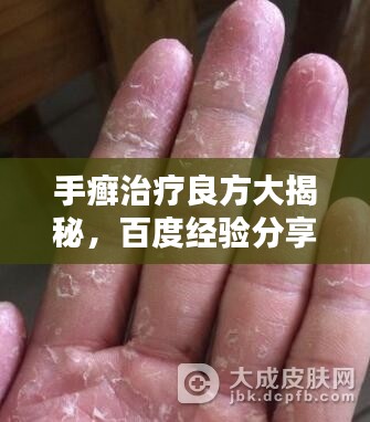 手癣治疗良方大揭秘，百度经验分享专区