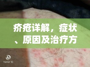 疥疮详解，症状、原因及治疗方法——百度健康为您解答