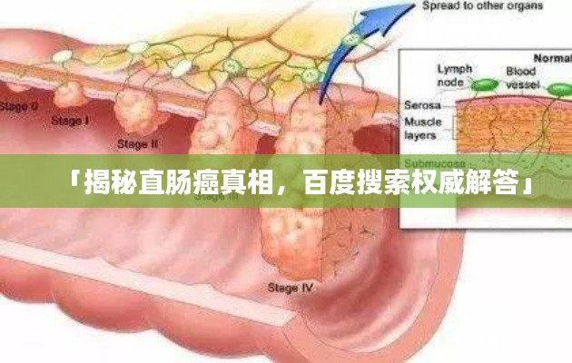 「揭秘直肠癌真相，百度搜索权威解答」