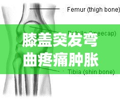 膝盖突发弯曲疼痛肿胀，原因解析、治疗指南与预防策略